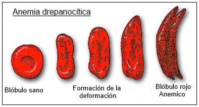 anemia drepanocítica
